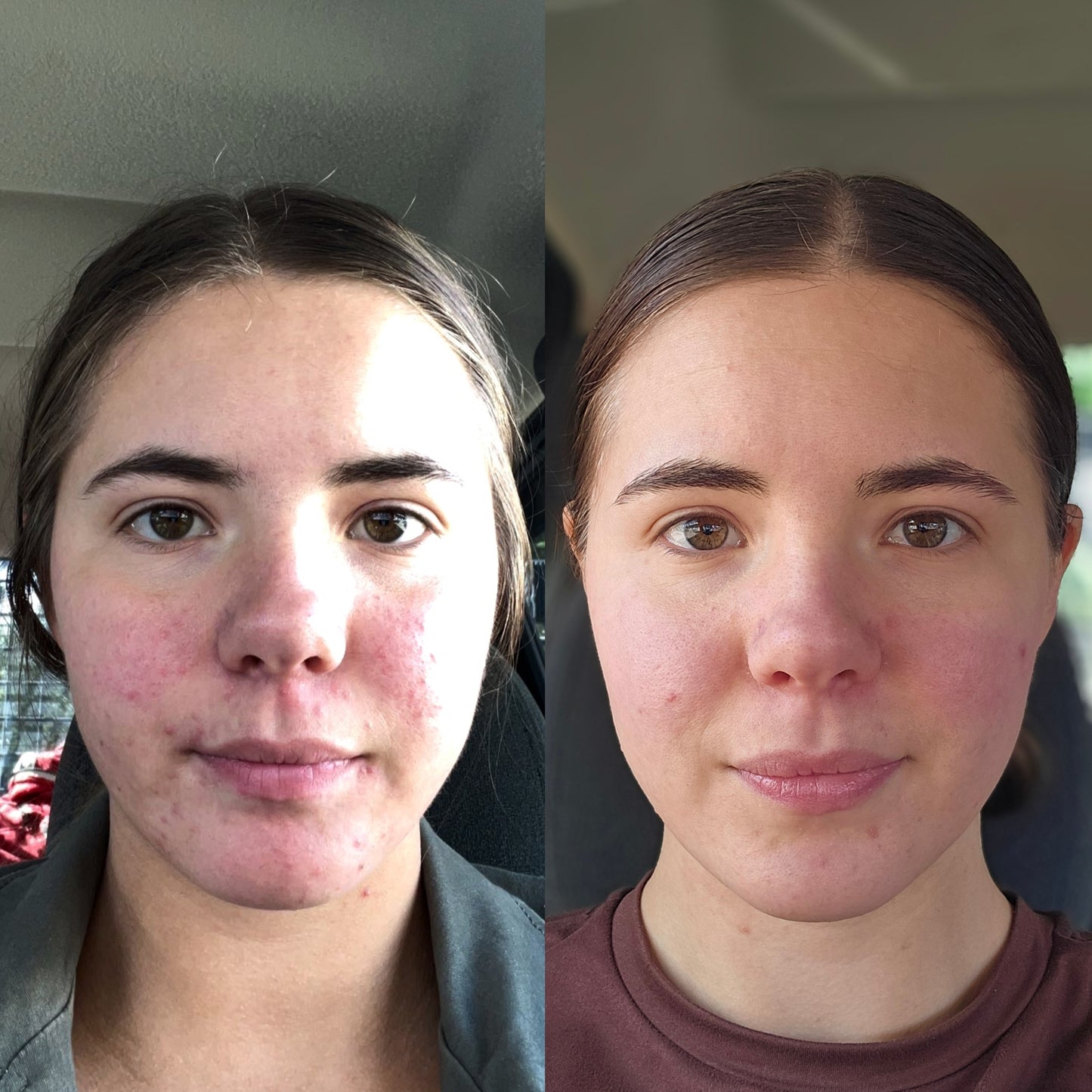 Clarifying Tallow Cream - For Acne-Prone, Sensitive Skin