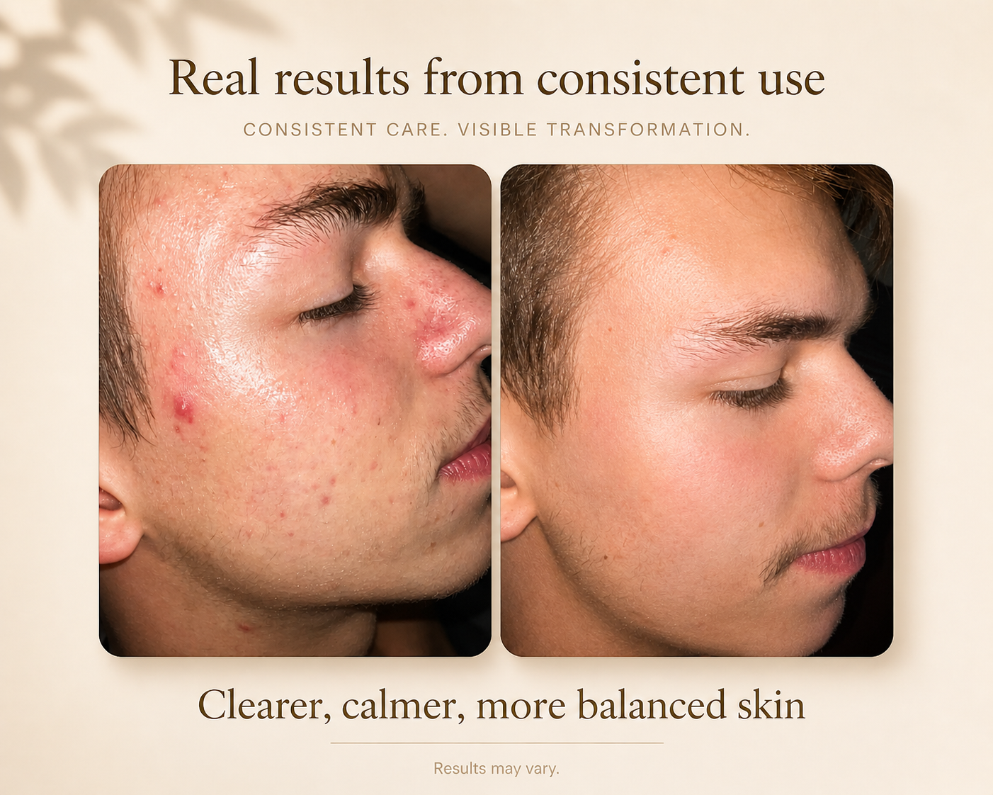 Clear Skin Complete System – Cleanse, Reset & Restore Acne Routine